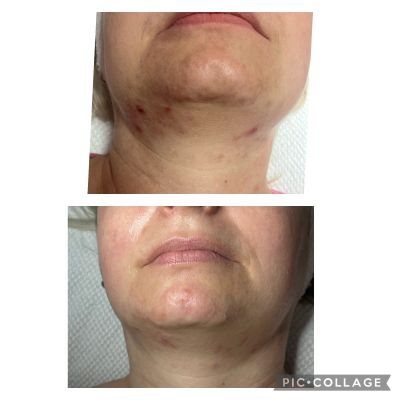 Eleganz Kosmetik Pigmentbehandlung 1